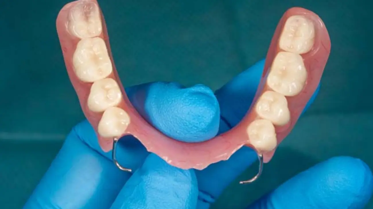 Visual representation of removable partial denture parts.