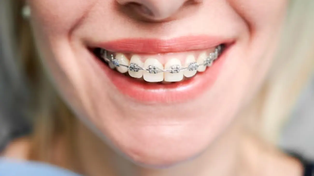 Patient receiving underbite braces treatment consultation.