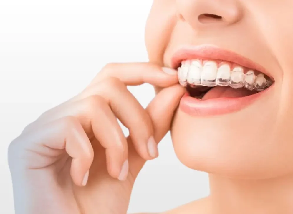 Invisalign clear braces for a perfect smile