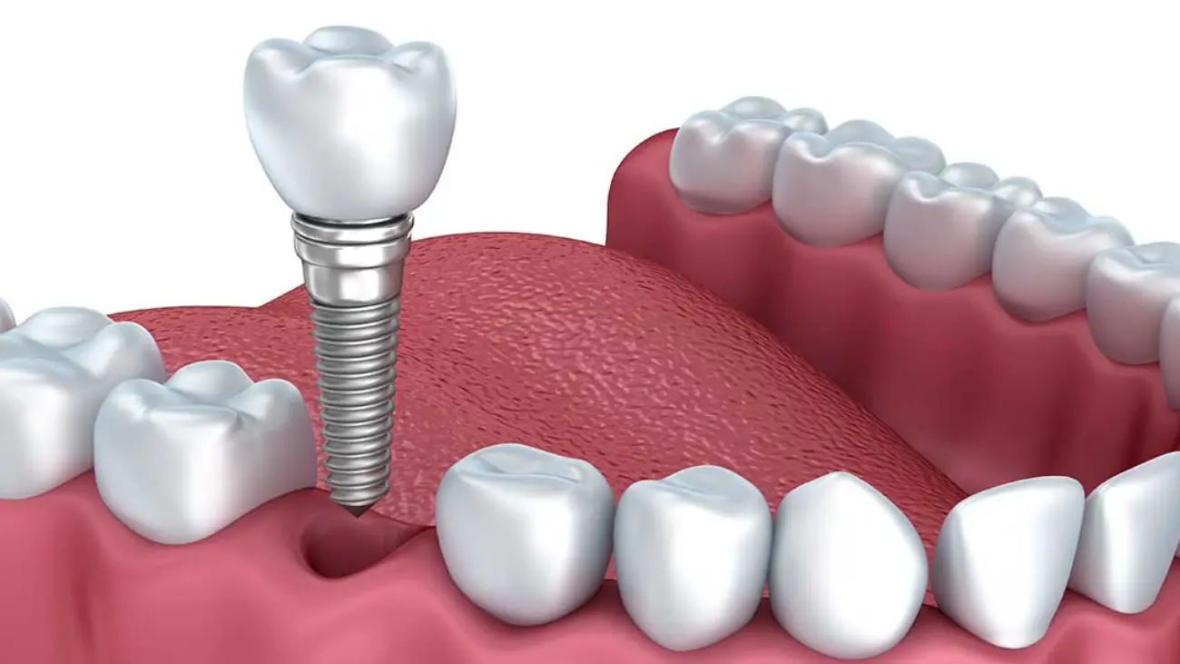 Dental Implants Service at ATOS Medical Center