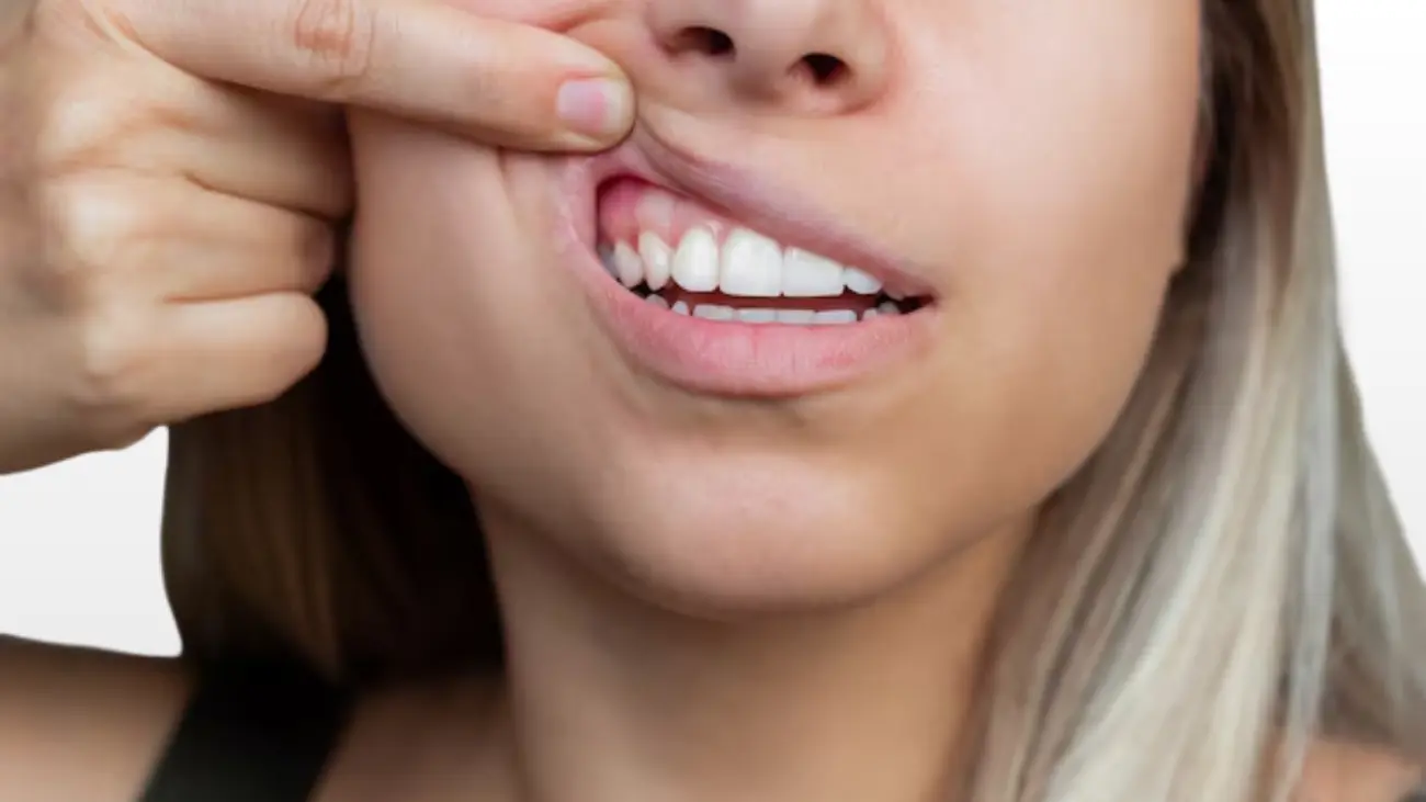 Gum boil treatment service at ATOS Medical Center