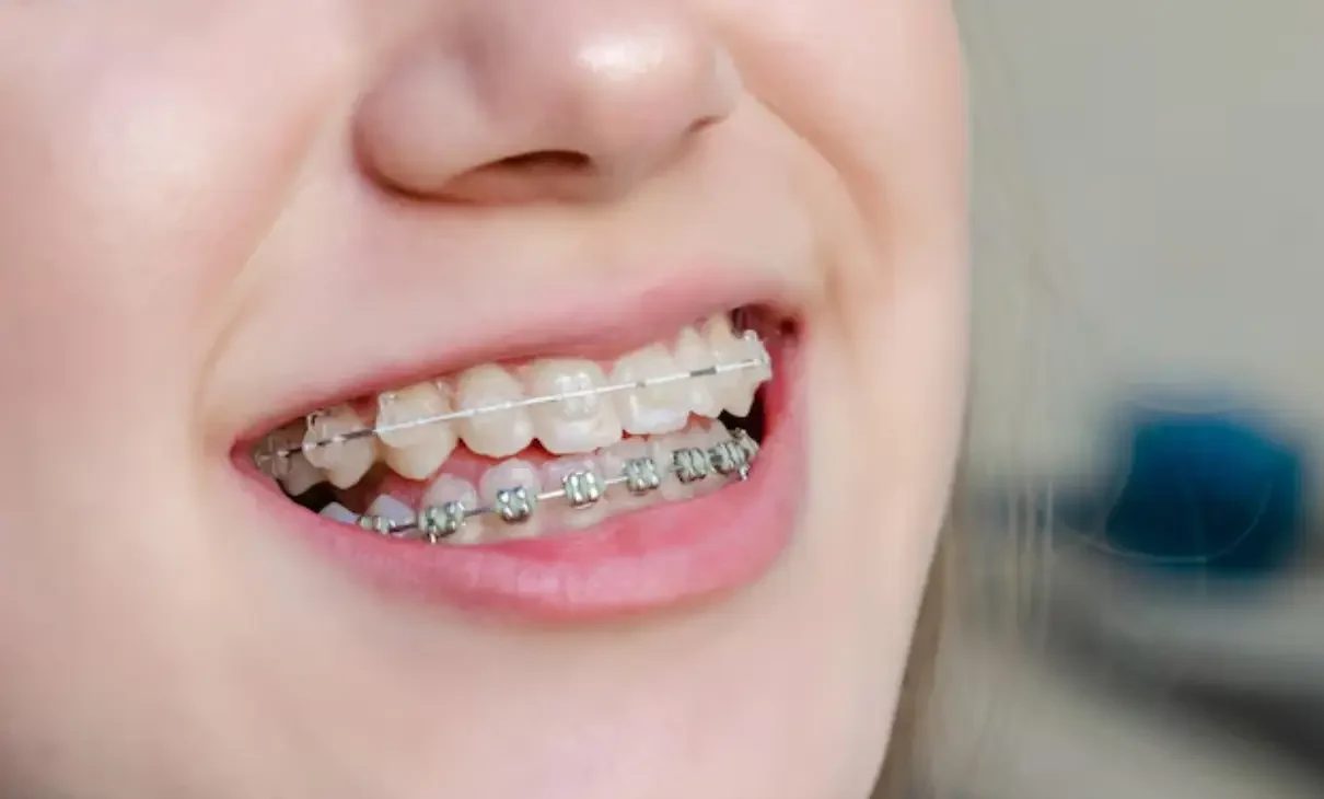 White metal braces enhancing a confident smile
