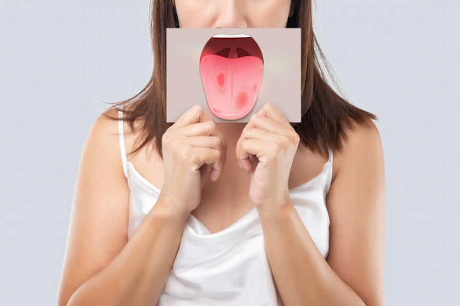 فطريات الفم: علاج فعال لمشاكل الفم