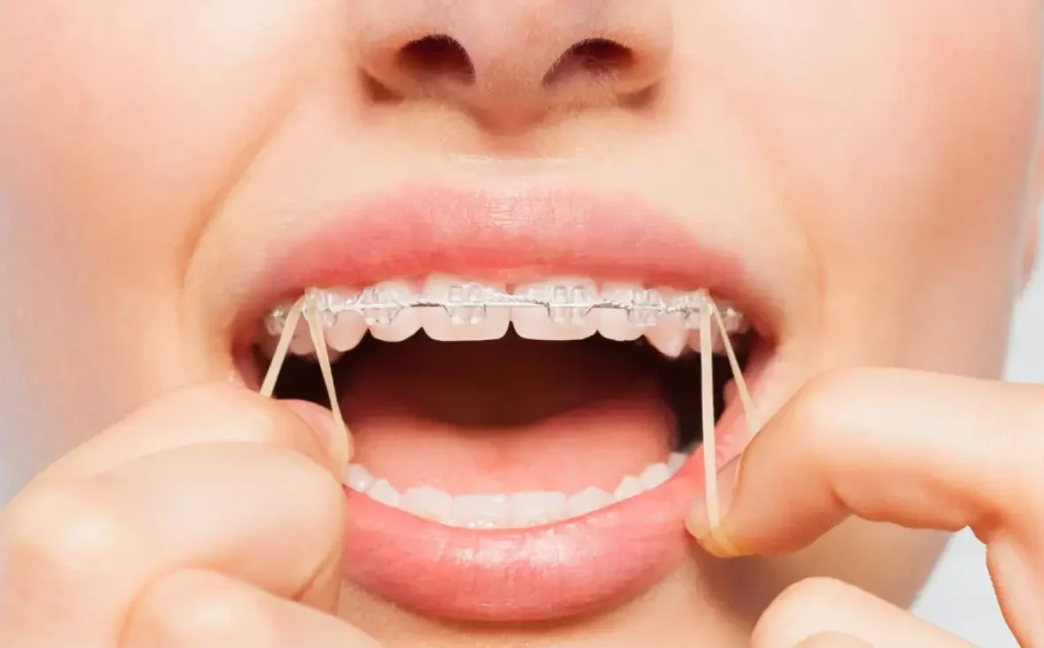 Braces without molar bands for a perfect smile