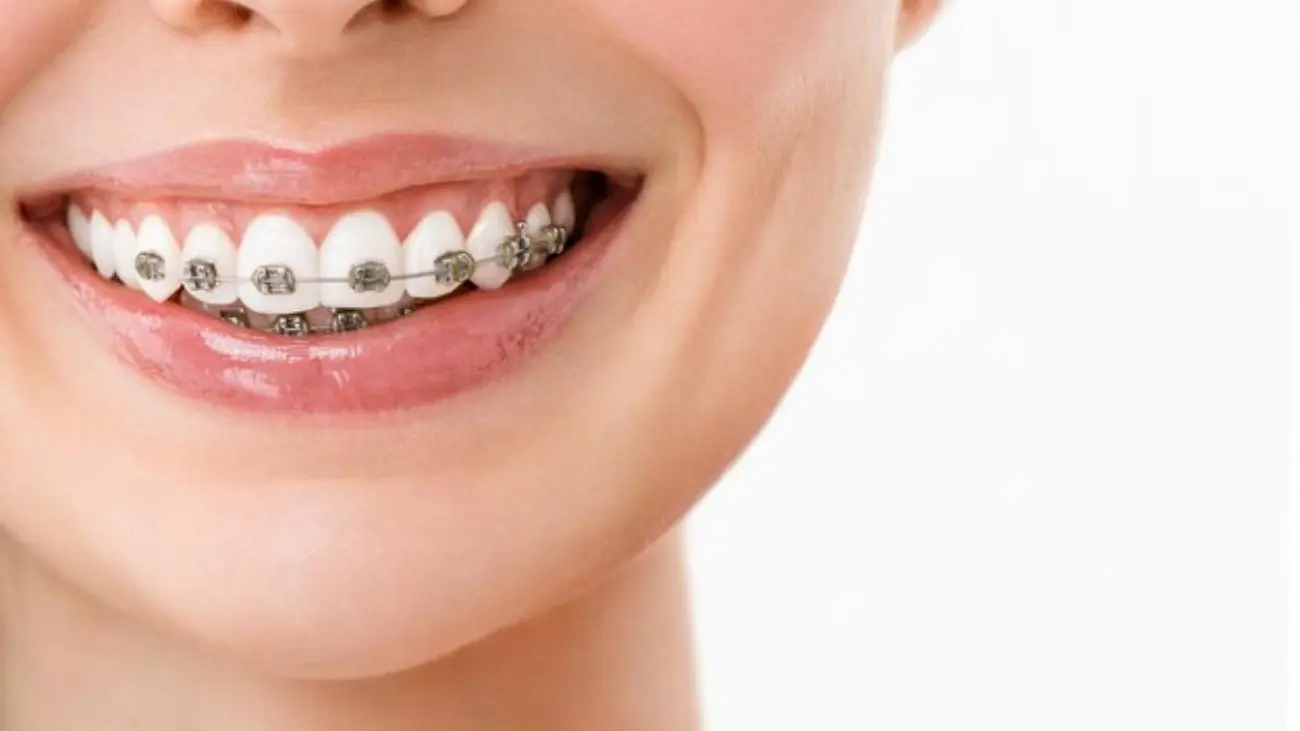 Patient with Ceramic Braces Smiling Confidently