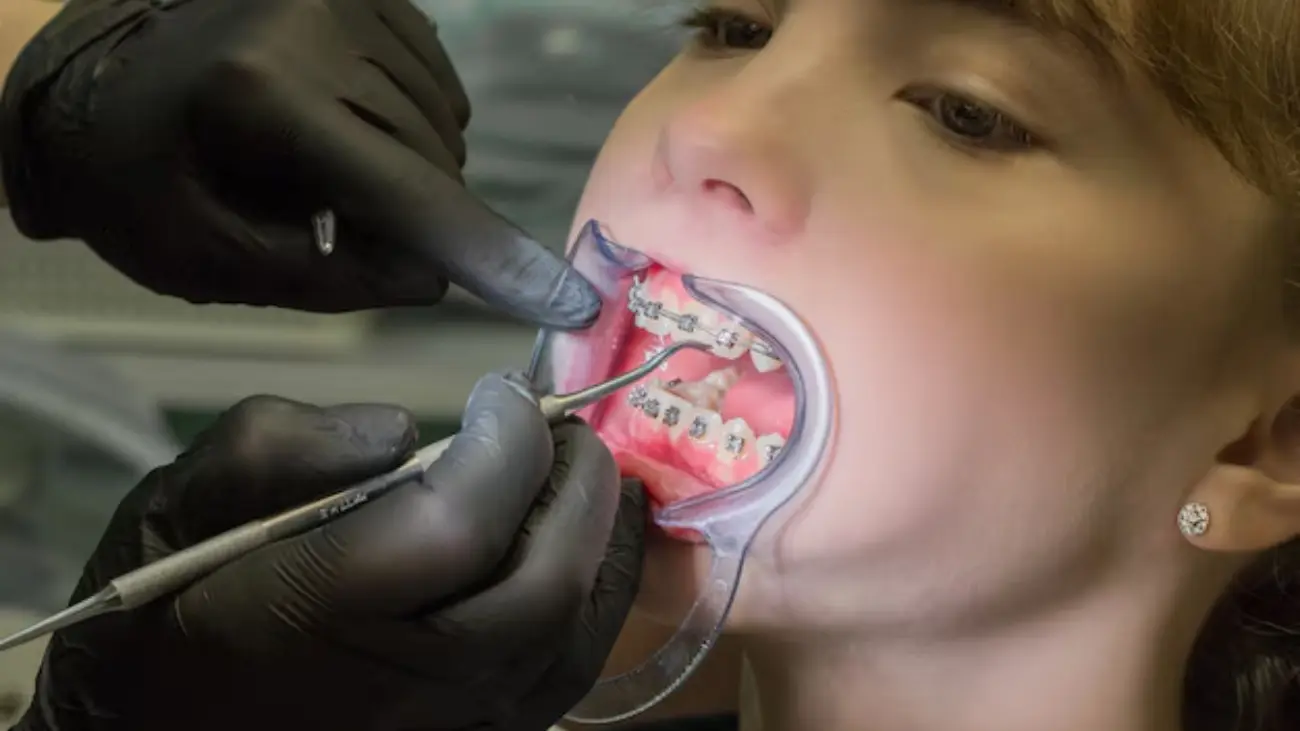 Braces pain relief strategies for patients in Qatar