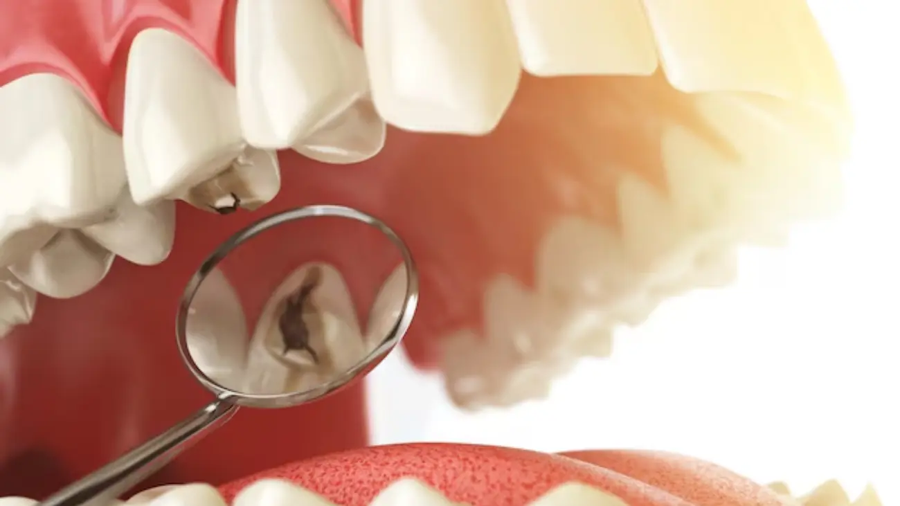 Cavity treatment service at ATOS Medical Center