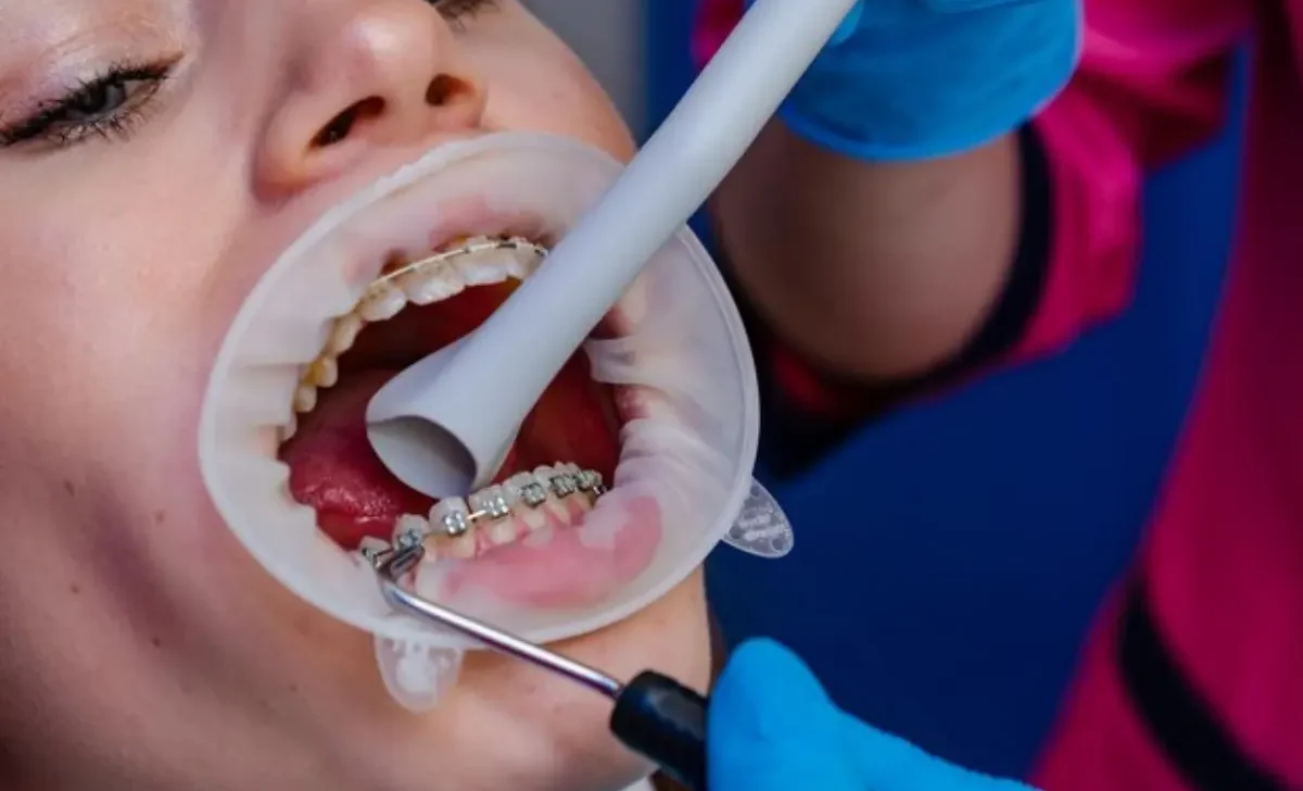 Braces tightened pain relief consultation in Doha