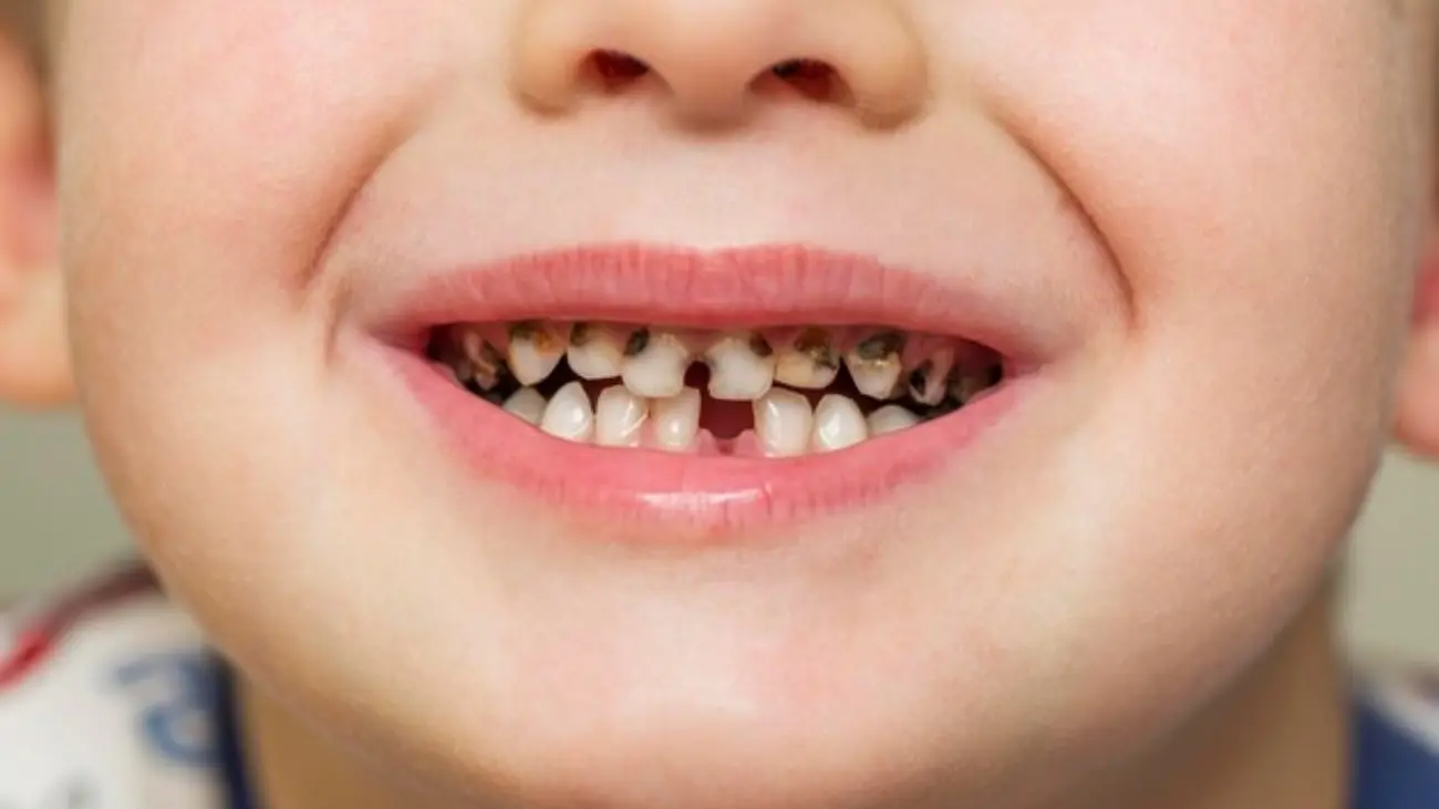 Teeth Full of Cavities Treatment in Doha