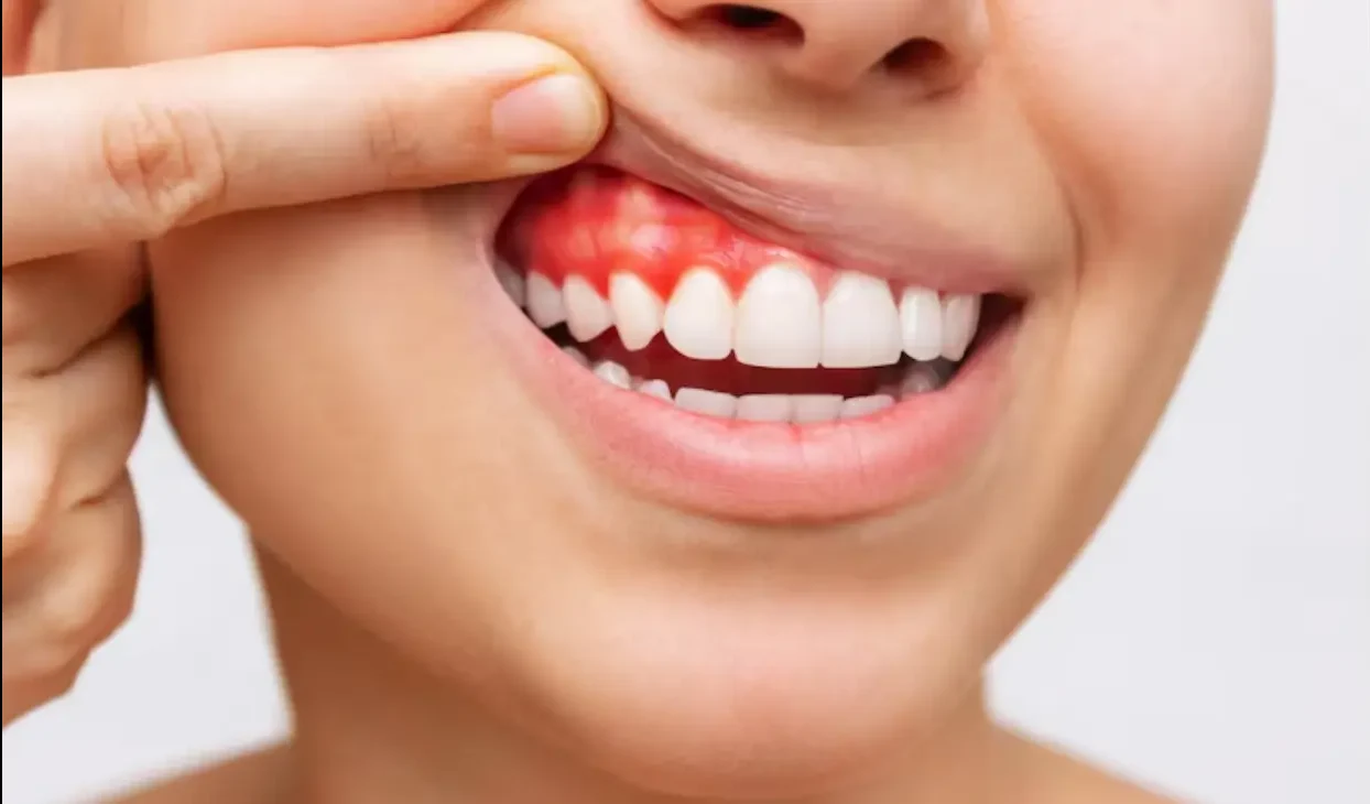 صورة توضح التهاب اللثة وعلاجه الفعّال