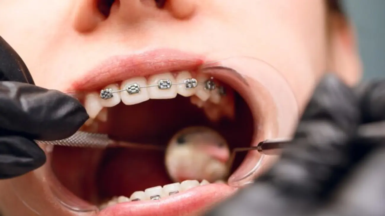 Patient receiving braces adjustment in clinic.