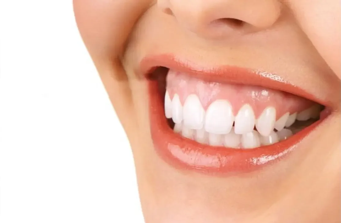 Gummy smile treatment for confident smiles
