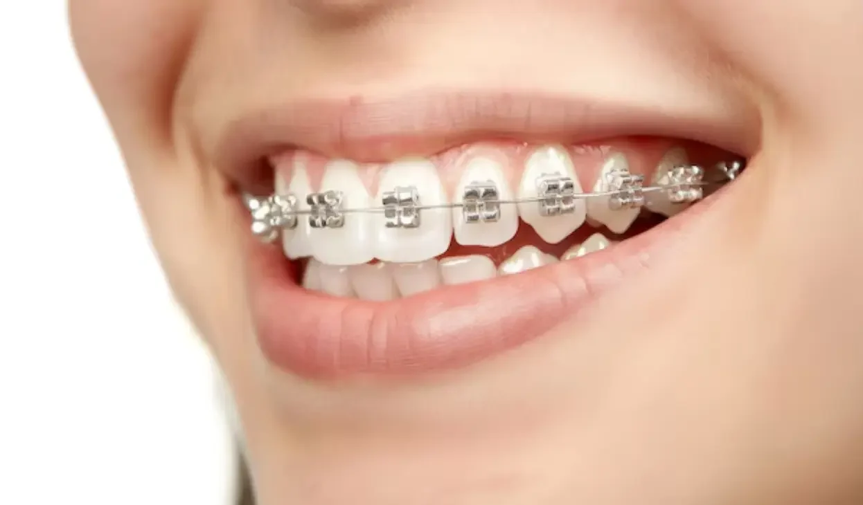 Ceramic Braces for a Beautiful Smile