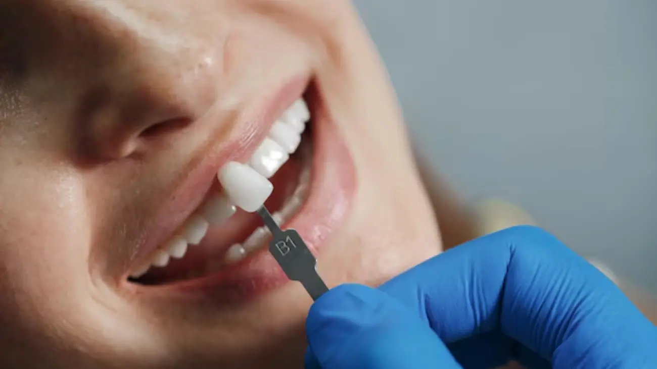 Restorative dental bridge solution in Qatar.
