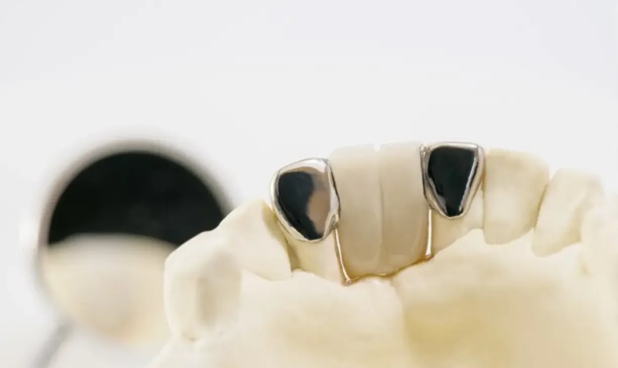 Titanium dentures shining against a professional backdrop.