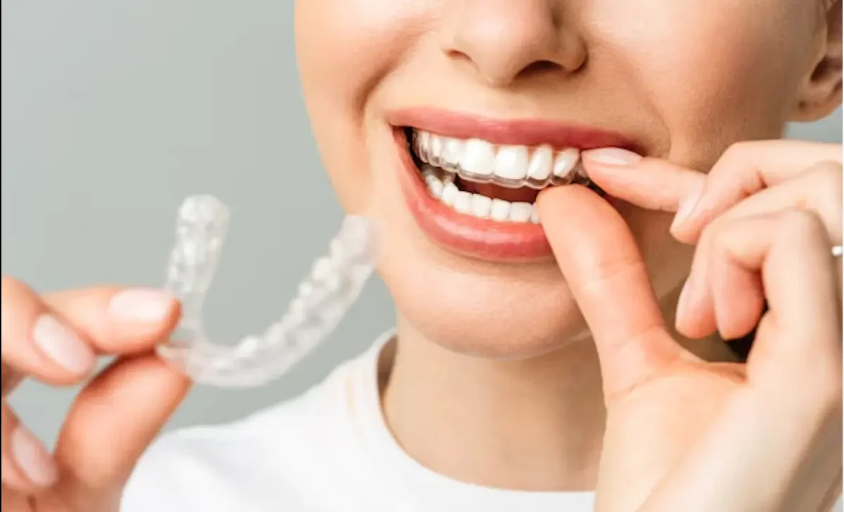 Teeth Braces for a Beautiful Smile