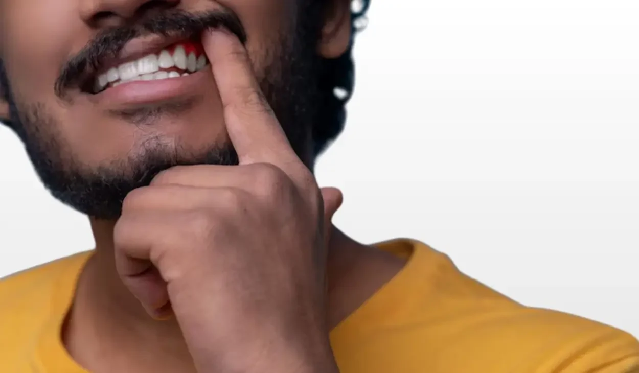 صورة توضح علاج انحسار اللثة في قطر