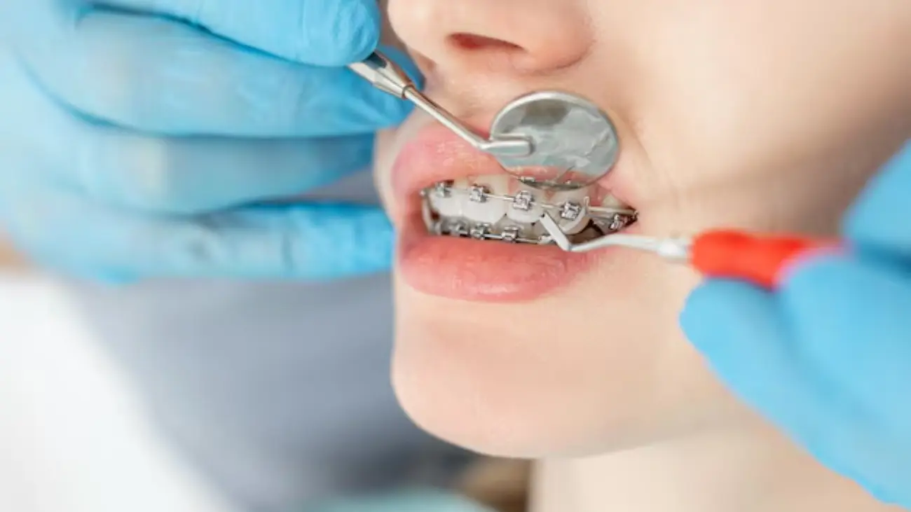 Patient smiling with traditional metal braces
