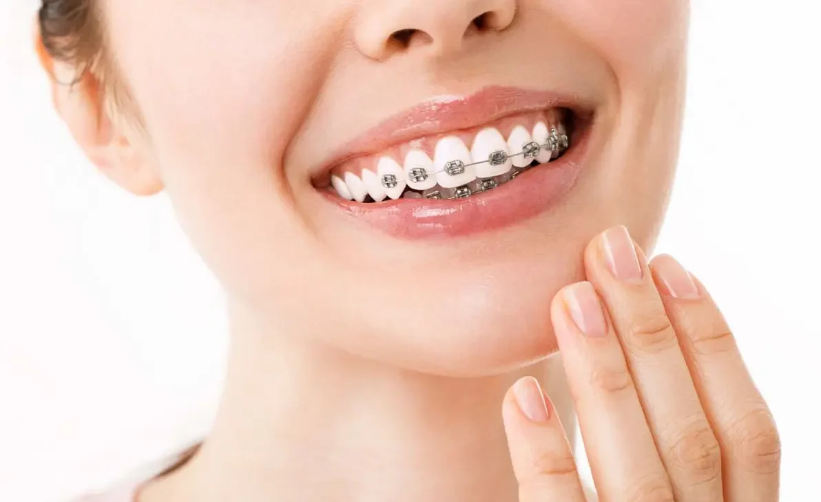 Traditional Braces for a Confident Smile Image