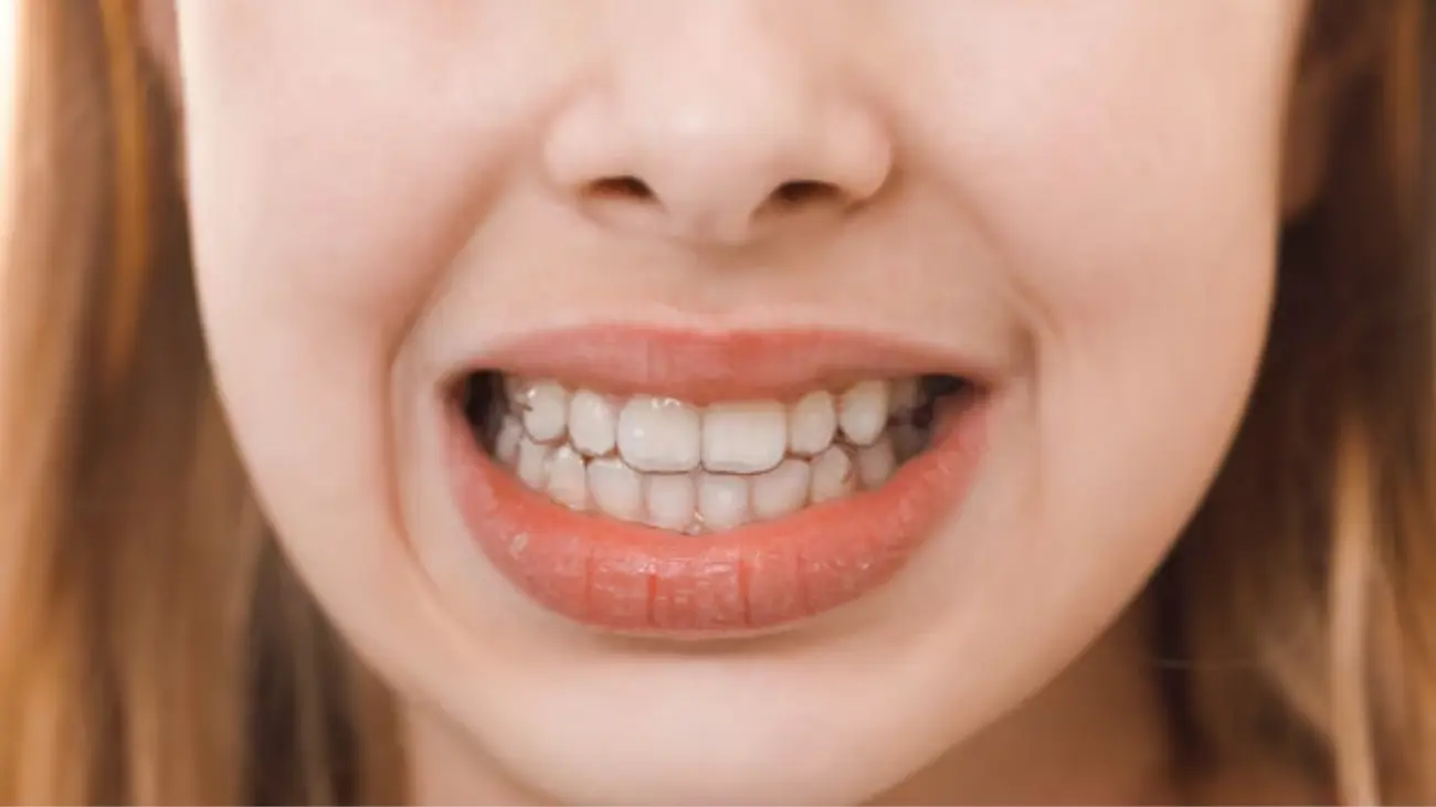 Crossbite treatment service at ATOS Medical Center