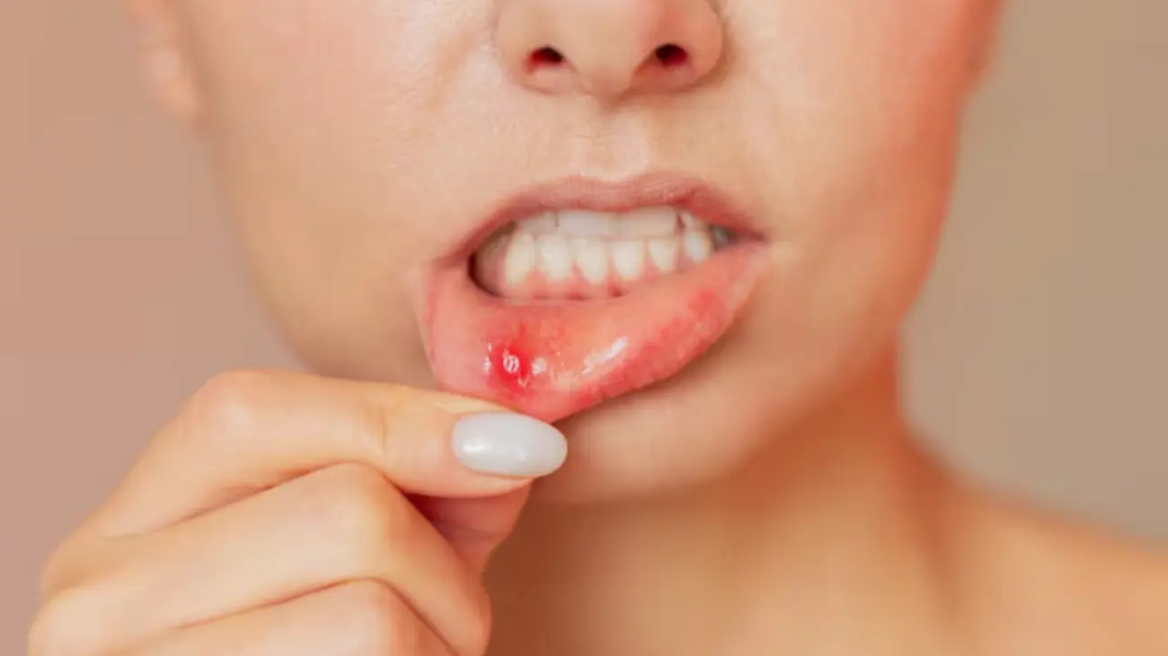 Canker sore treatment at ATOS Medical Center