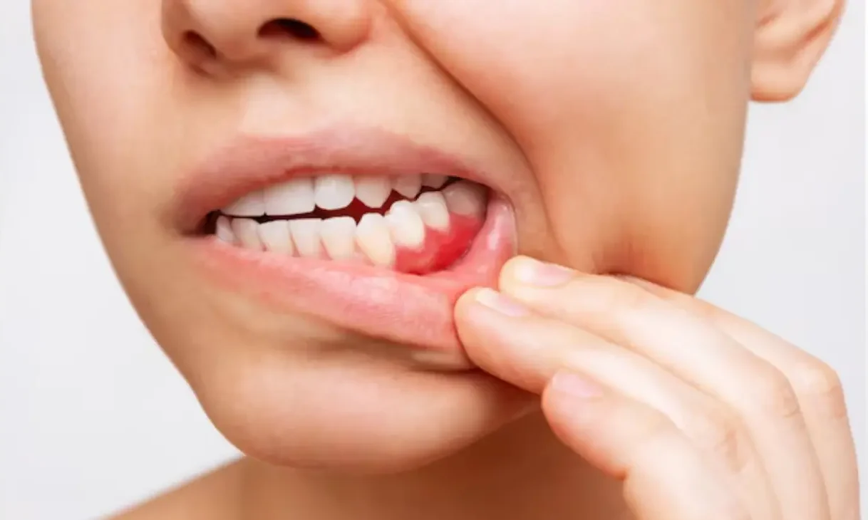 Gum Disease Treatment at ATOS Medical Center
