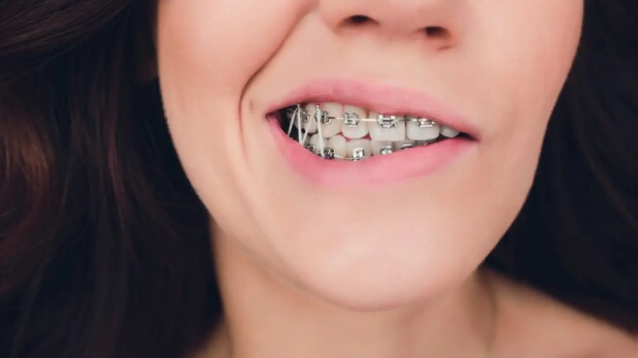 Innovative braces for a seamless orthodontic experience