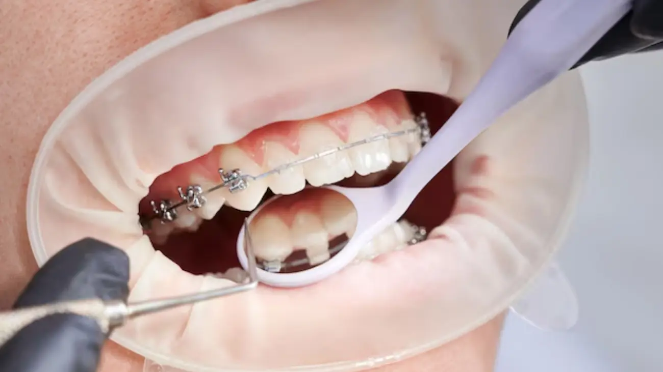 Achieve Your Ideal Smile with 6 Month Braces