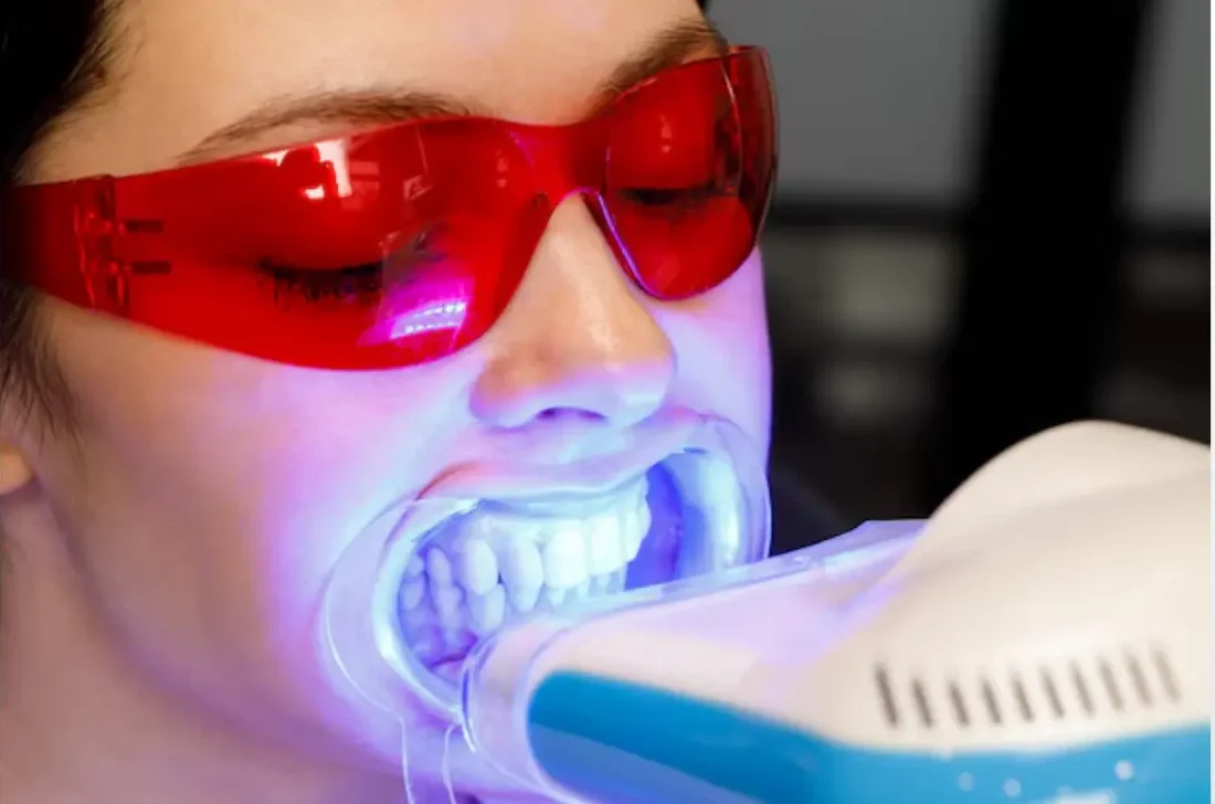 Teeth bleaching service at ATOS Medical Center