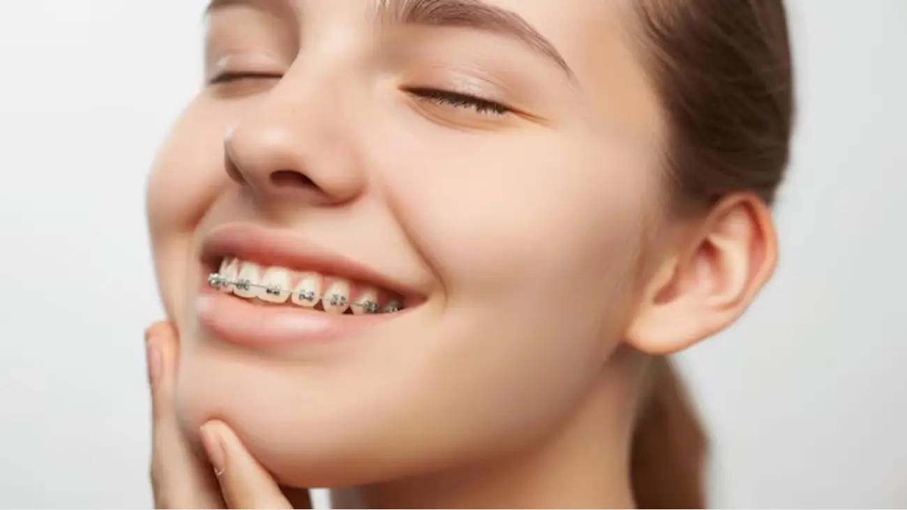 6 Month Smile Braces for a Confident Smile