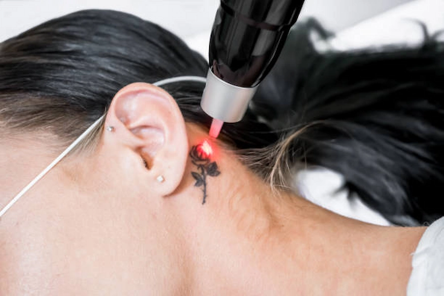 Tattoo Removal for Face and Neck procedure image