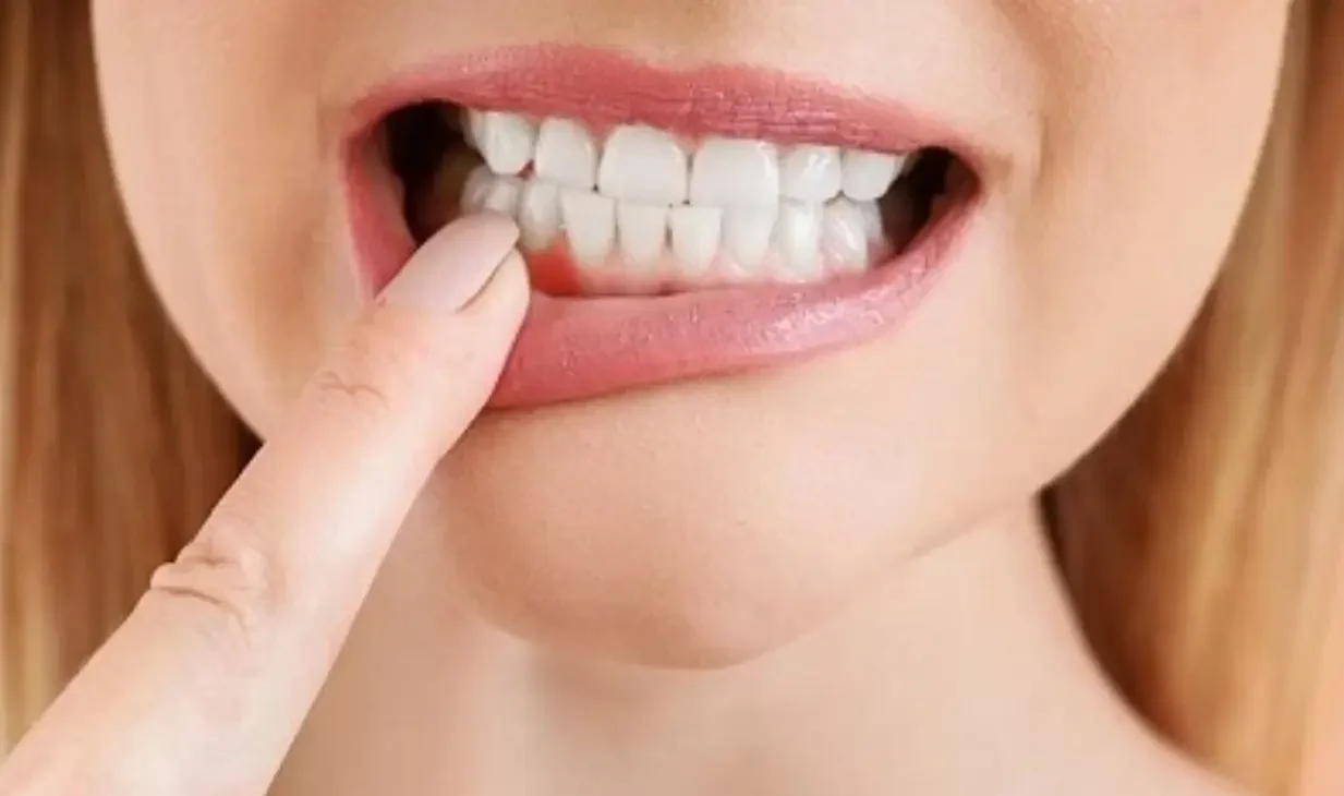 ابتعاد اللثة عن الأسنان وعلاجاتها المتقدمة
