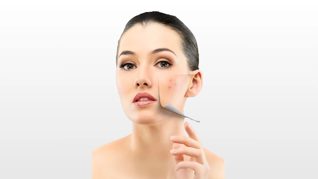 Cheek acne treatment at ATOS Medical Center