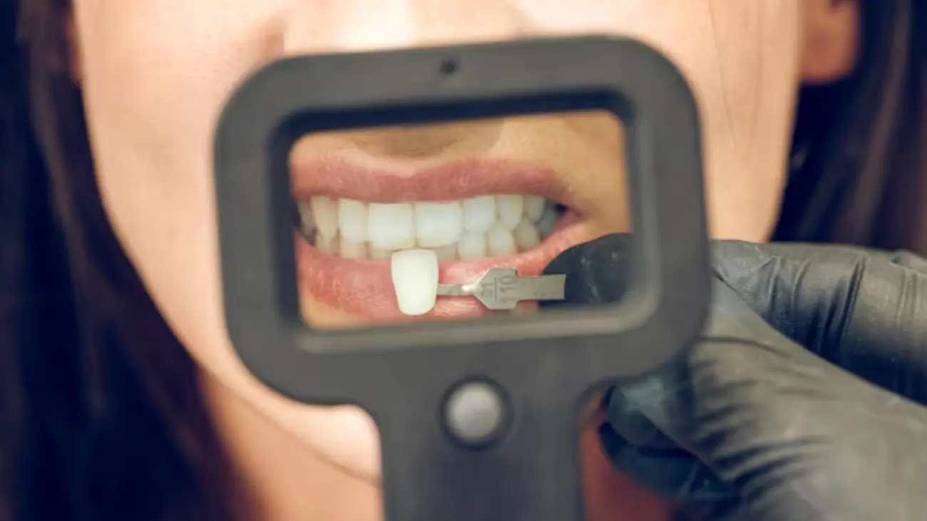 Composite resin bonding for dental aesthetics