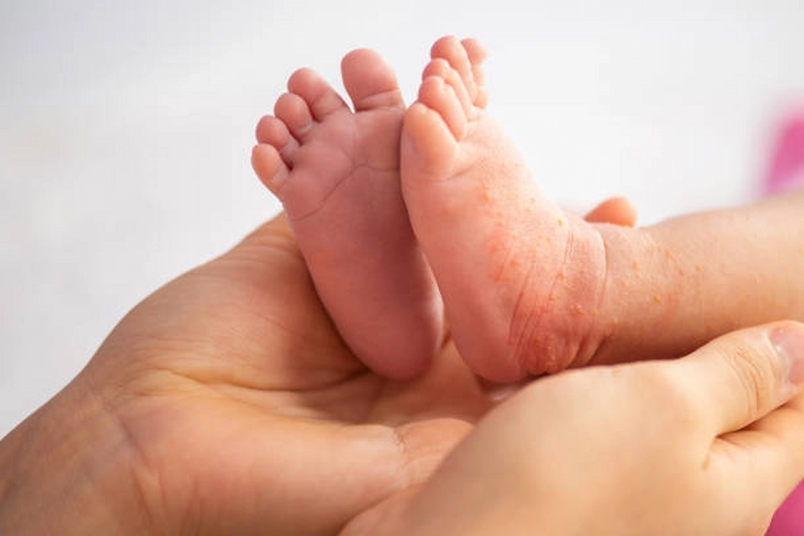 صورة توضح علاج الاكزيما عند الرضع