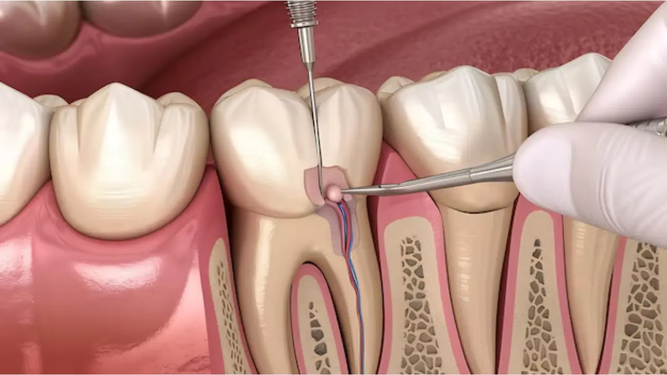 Root canal abscess treatment at ATOS Medical Center