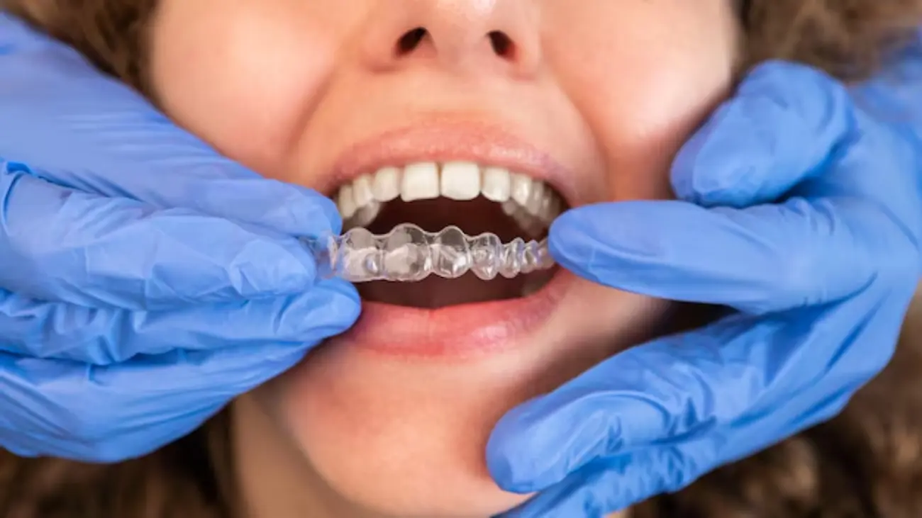 Invisalign dentist consultation for a perfect smile