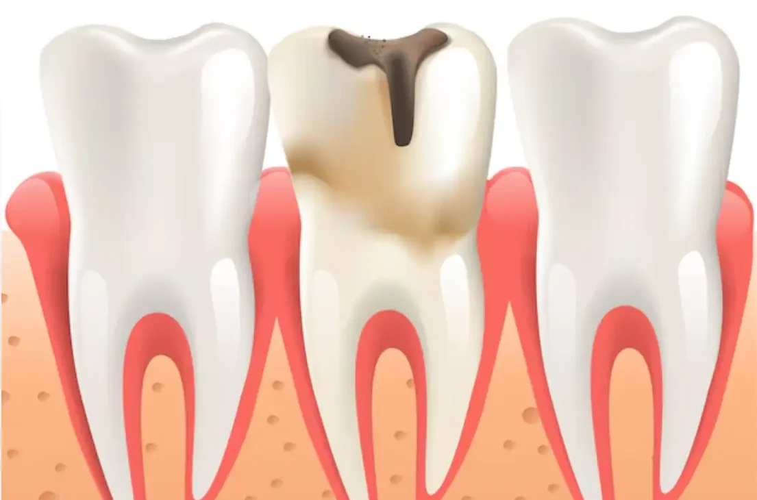 Caries dental treatment for healthy smiles