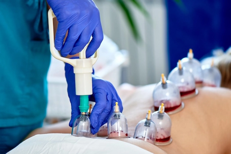 Cupping Therapy treatment at ATOS Medical Center