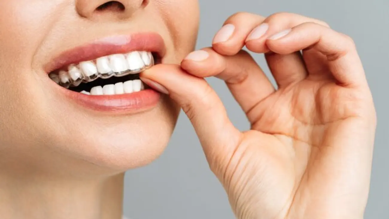 Transforming smiles with clear path aligners