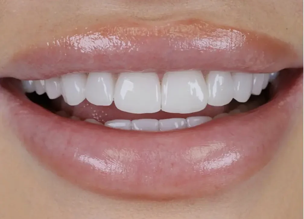 PFM Dental Crown service at ATOS Medical Center