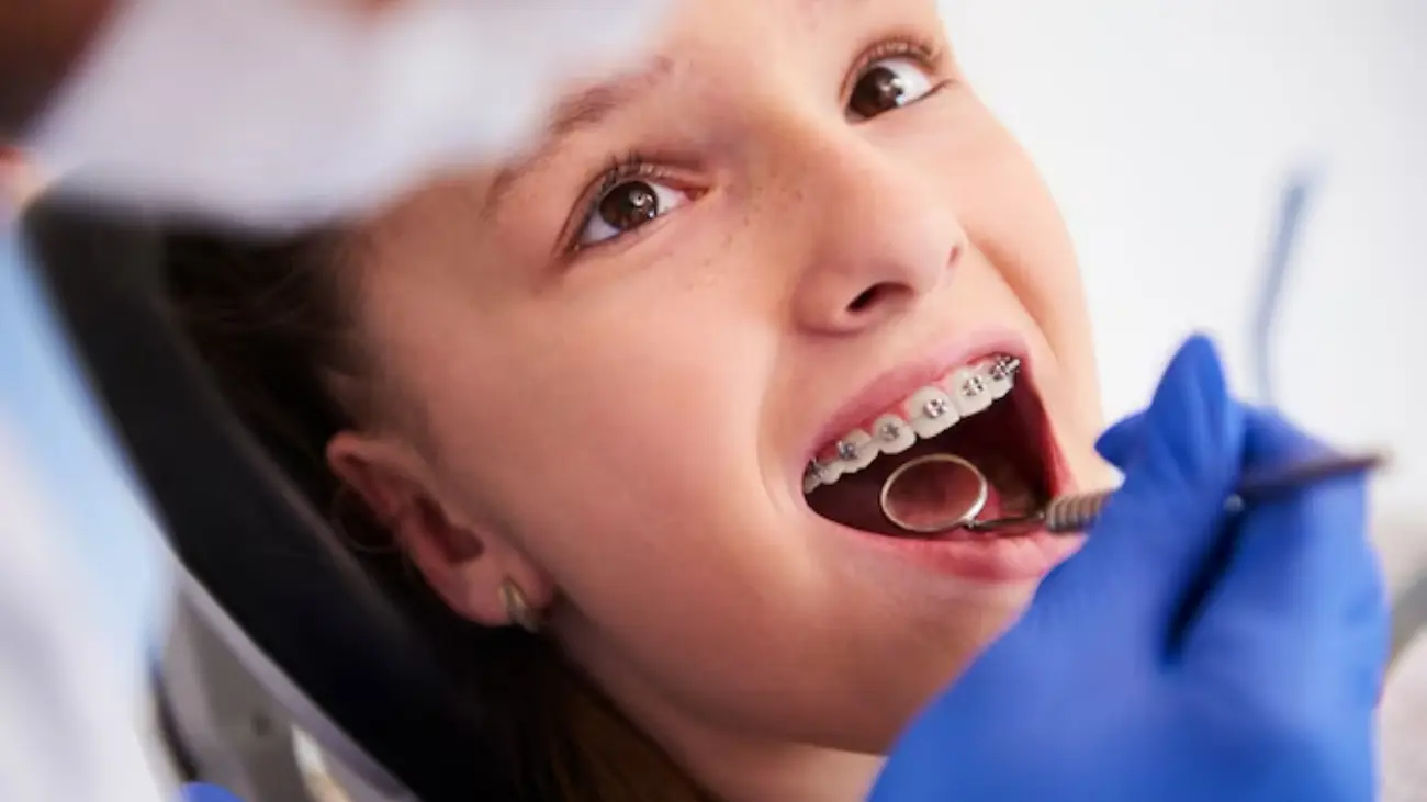 Effective solutions for braces discomfort relief.