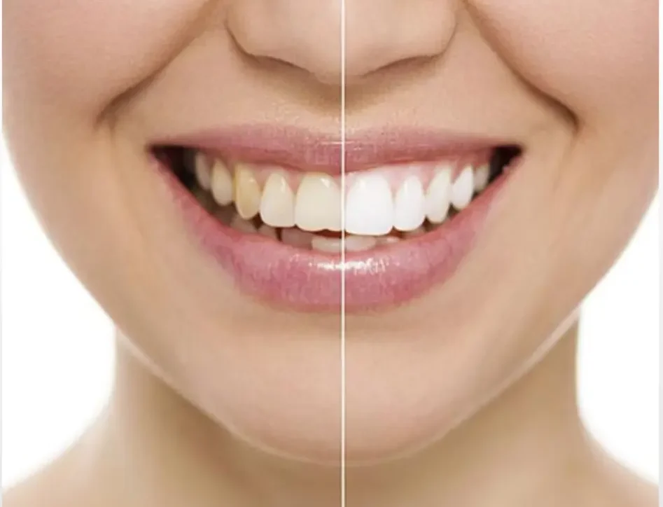 Tooth Discoloration Treatment at ATOS Medical Center