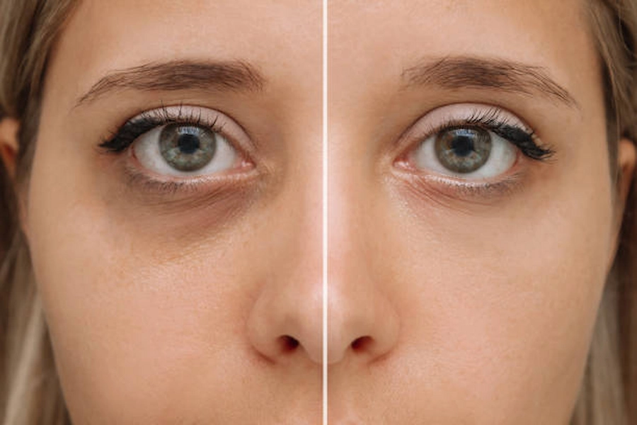Before and after Dark Under Eyes Treatment results