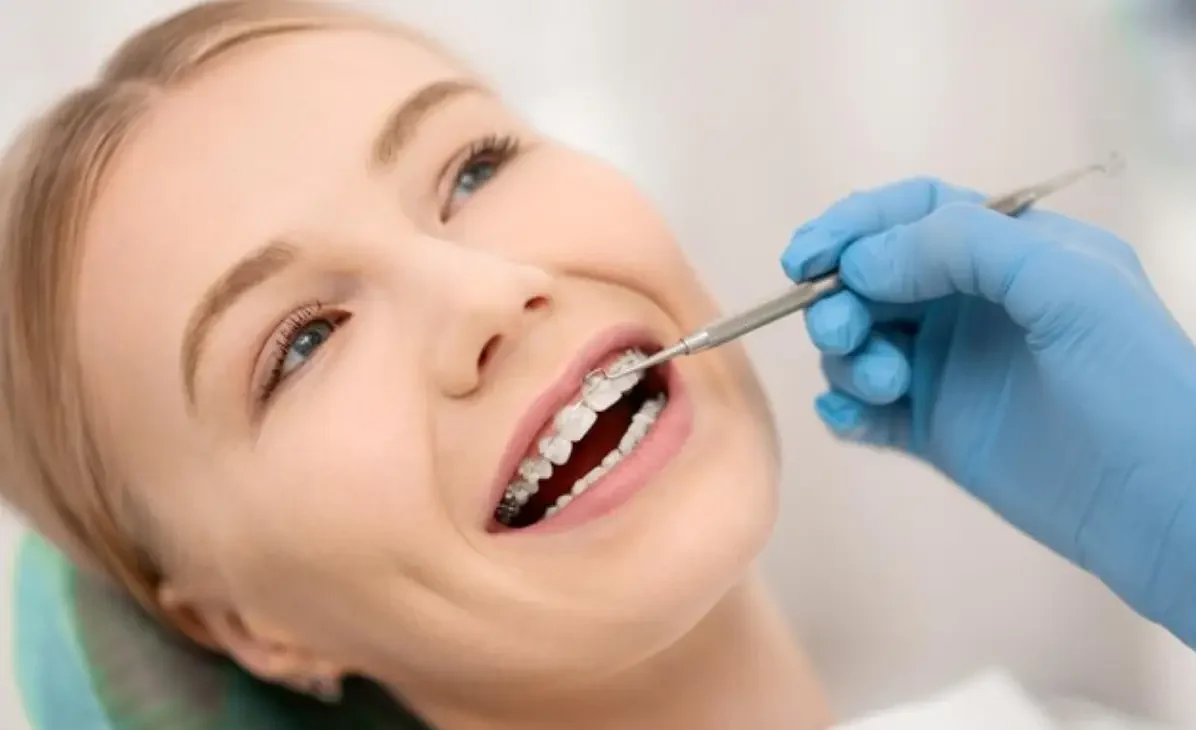 Types of Braces for Dental Health Solutions