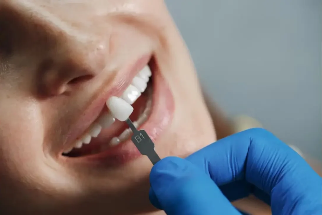 Crown service for a stunning smile transformation