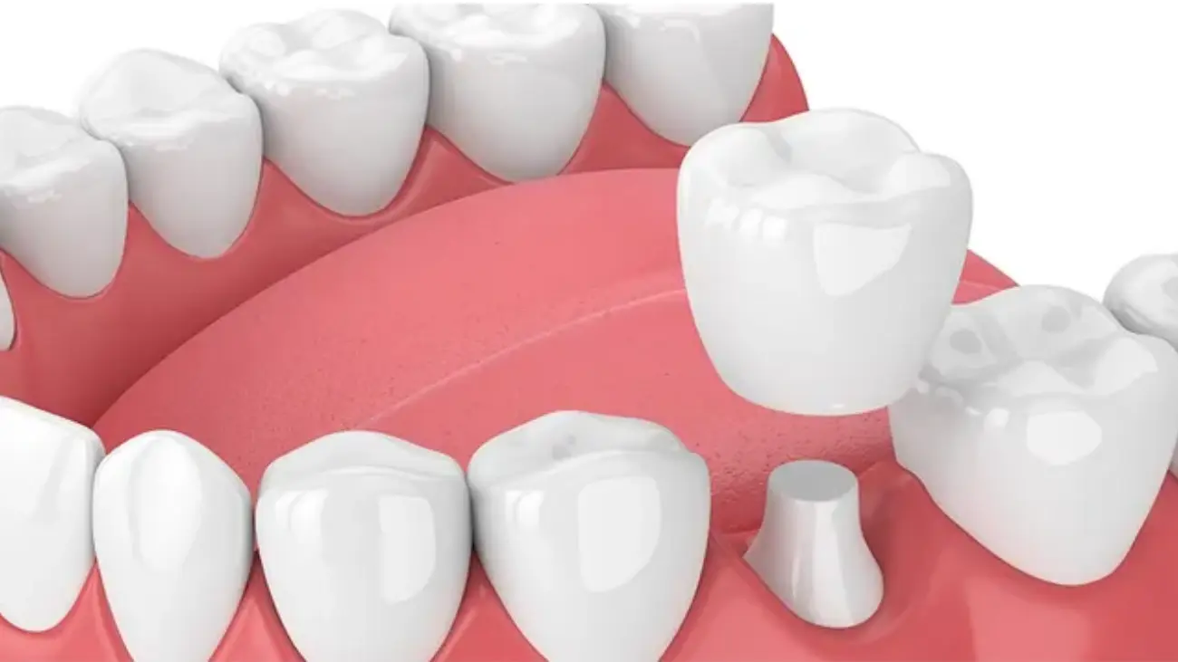 Dental Crown service showcasing radiant smiles