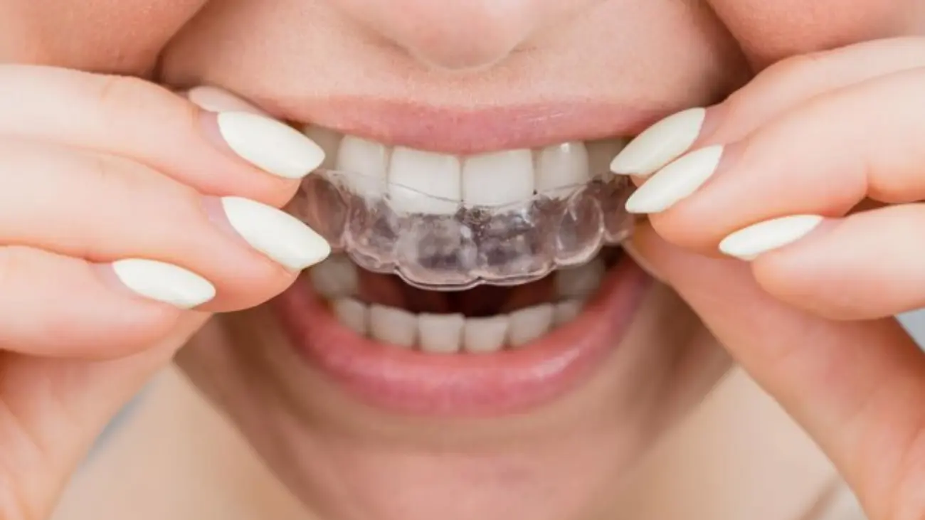 Flexible removable braces offered in Qatar.