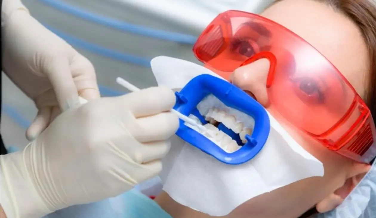Close-up of White Composite Filling Application