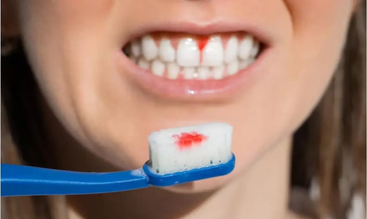 Bleeding Gum treatment at ATOS Medical Center